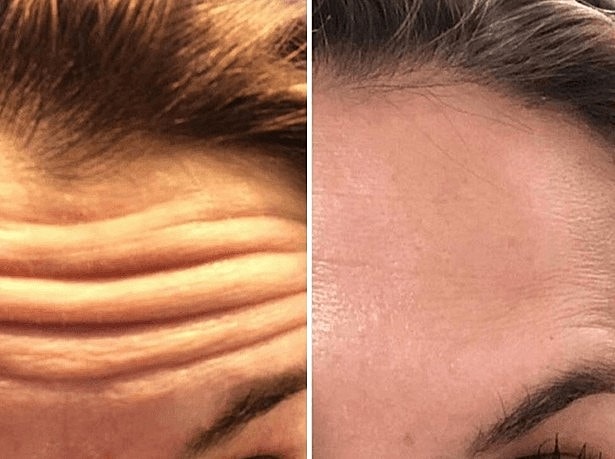 What is the Best Non-Surgical Method for Reducing Wrinkles?