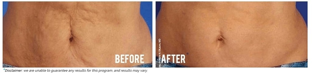 Can I Tighten My Skin Without Surgery?