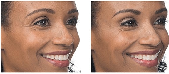 Do Botox Injections Hurt?