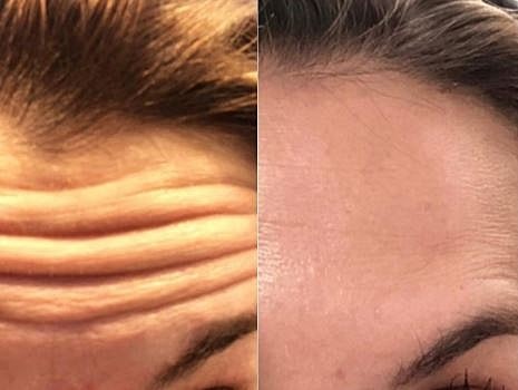 How Can I Get Rid of Crow’s Feet?