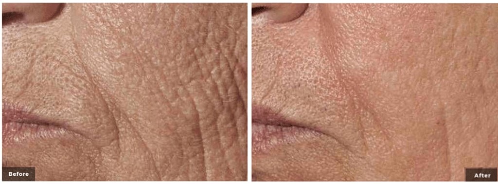 How Long is the Recovery from Laser Skin Resurfacing?