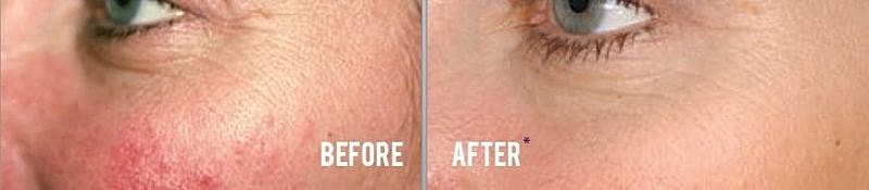 close up patient before and after of cheek