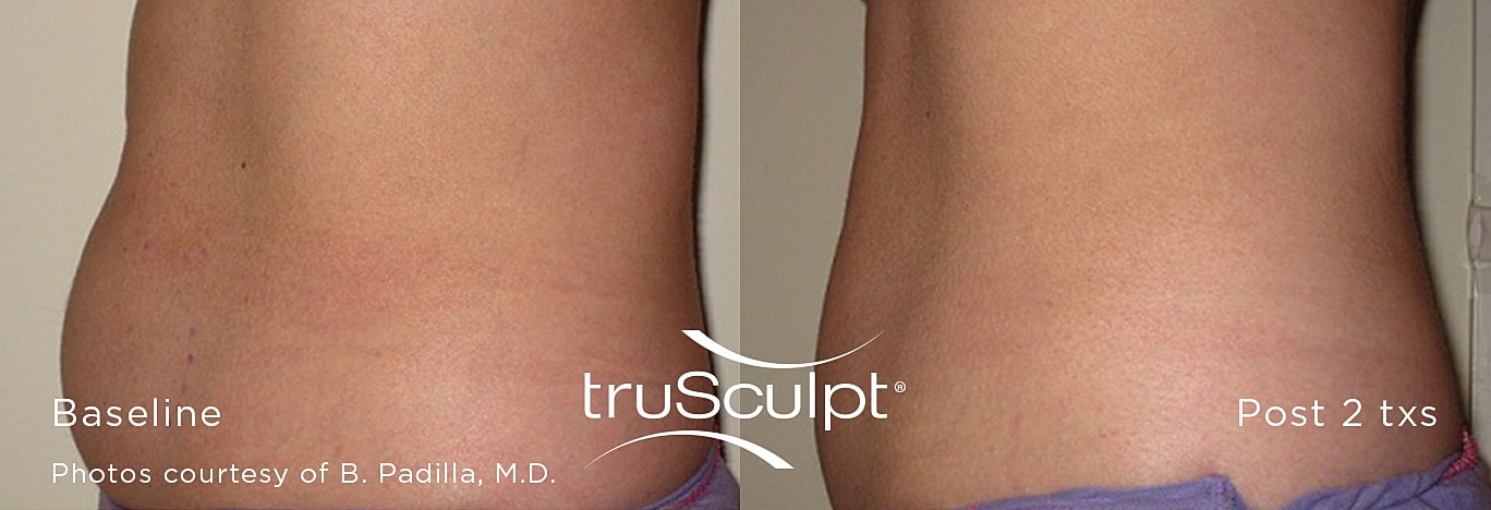 Before and after truSculpt treatment results.
