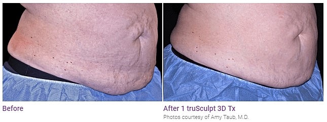 Before and after truSculpt 3D treatment results.